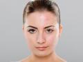 Acne | Skindoc Dermatologists | Liverpool Sydney | Dr Jennifer Yip