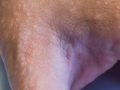 Eczema | Skindoc Dermatologists | Liverpool Sydney | Dr Jennifer Yip