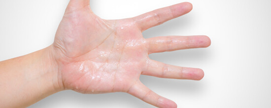 Excessive Sweat | Skindoc Dermatologists | Liverpool Sydney | Dr Jennifer Yip
