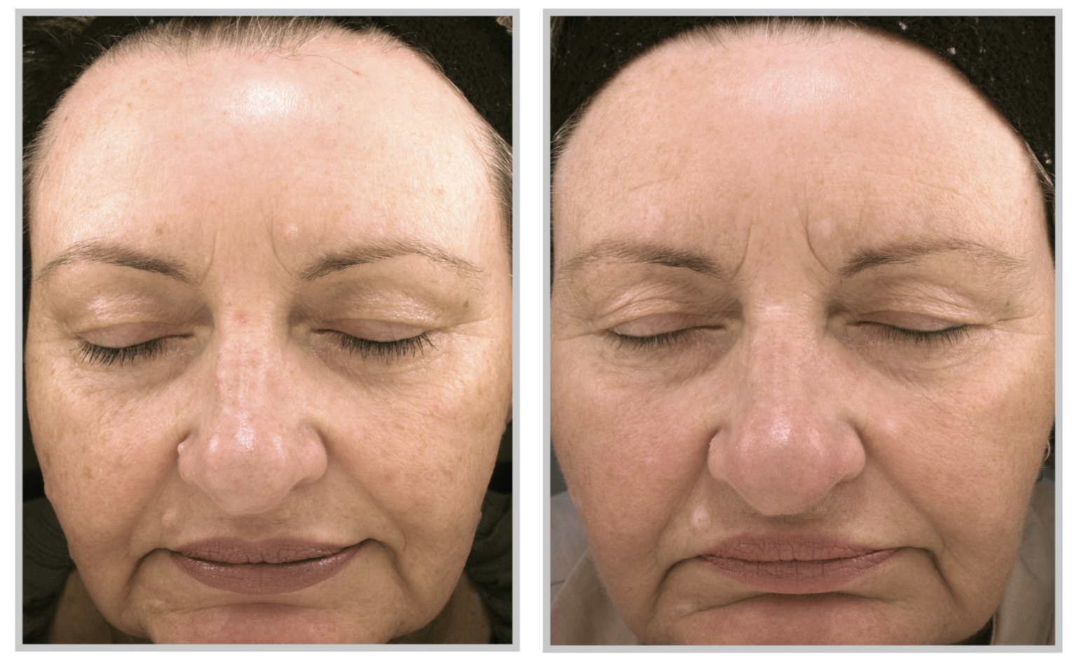 BBL PhotoFacial Treatment SkinDoc Naturally Regenerated Skin