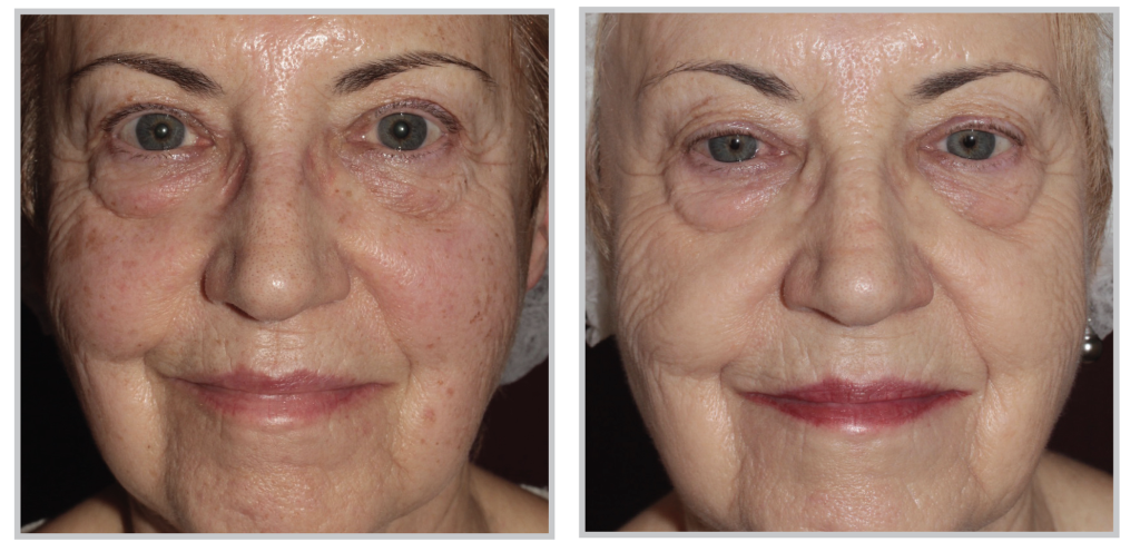 Bbl Photo Facial Treatment Skindoc Naturally Regenerated Skin